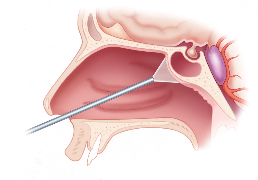 Endoscopic Sinus & Skull-Base Surgery